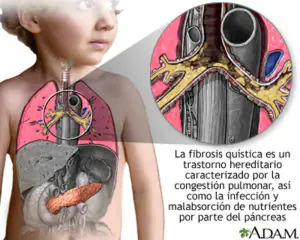 fibrosis-quistica