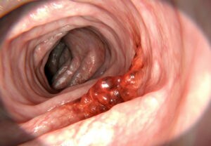 Untreated colorectal polyps can develop into colorectal cancer